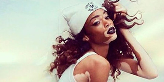 Kontestan America's Next Top Model ini pede dengan vitiligo