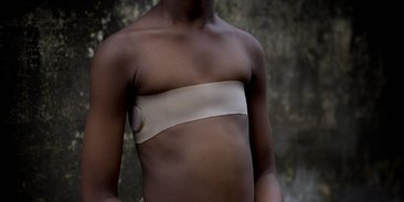 Setrika Payudara, Praktik Kekerasan terhadap Perempuan Afrika yang Jarang Disorot