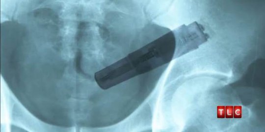 Nyawa melayang gara-gara vibrator tersangkut di tubuh