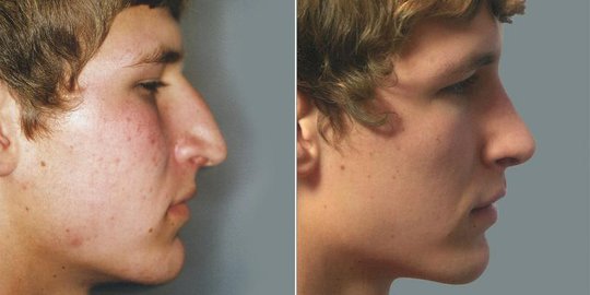 5 operasi plastik termahal yang tawarkan kecantikan instan