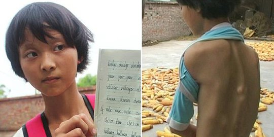 Perempuan China ini menderita Sindrom Manusia Batu