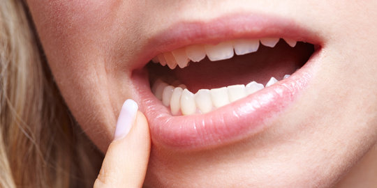 Atasi virus herpes di mulut dengan 8 cara mudah ini