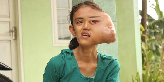 Menderita tumor ganas, Anggi hanya bisa pasrah