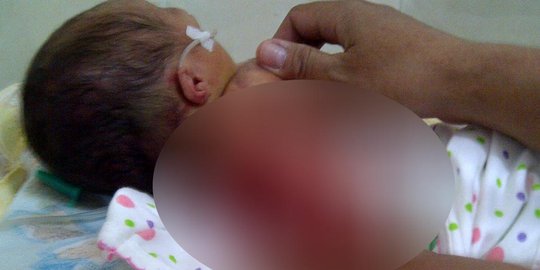 Kepanasan di inkubator, kulit bayi 5 hari melepuh lalu meninggal