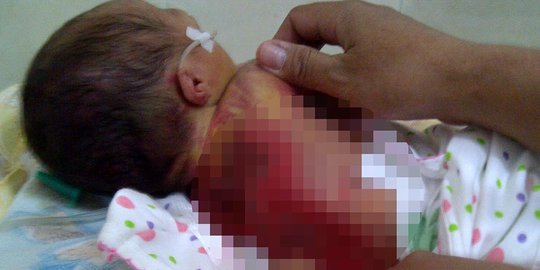 Cerita tragis bayi tewas 'terpanggang' di inkubator rumah sakit