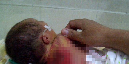 melepuh karena terpanggang inkubator rev2