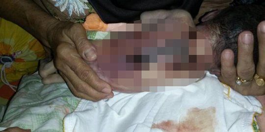 rumah sakit lain terungkap punggung bayi melepuh rev2