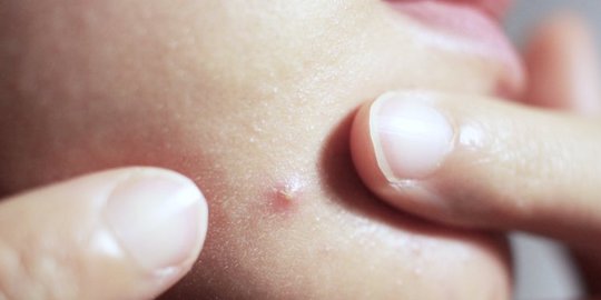 Bahaya Konsumsi Gula Berlebihan Bagi Kecantikan