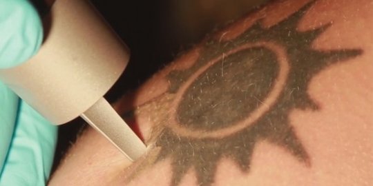 Bagaimana cara laser bisa hapus tato di kulit?