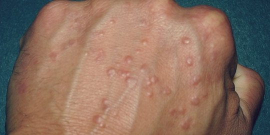 deteksi penyakit diabetes lewat 7 tanda di kulit ini