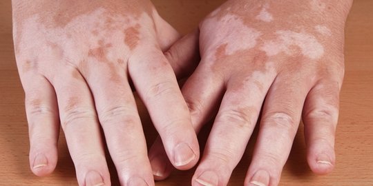 deteksi penyakit diabetes lewat 7 tanda di kulit ini
