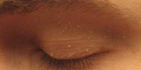 waspadai 5 penyakit kulit yang mengintai di area sekitar mata!