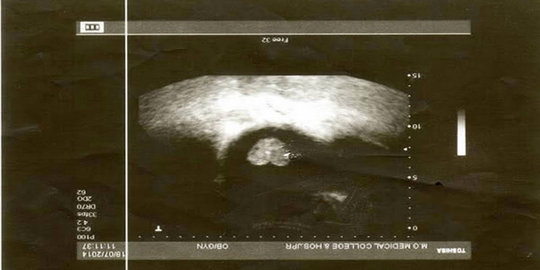 bentuk hati ditemukan di india rev2