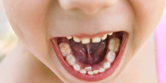 Ketahui 3 fakta penting tentang gigi bungsu
