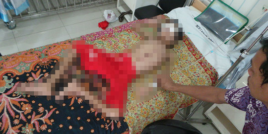 Anak SD menderita tumor di wajah, keluarga kesulitan biayai operasi