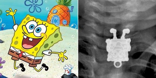 Bocah Saudi tak sengaja telan mainan Spongebob