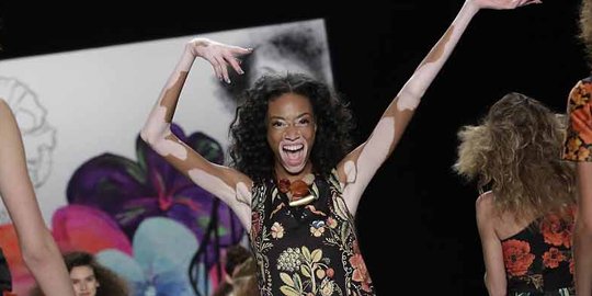 Mengenal Winnie Harlow, wanita pengidap vitiligo yang jadi model top