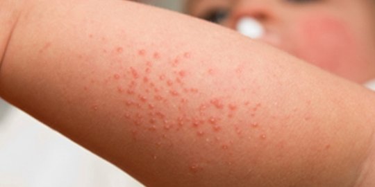 awas, 6 infeksi kulit ini mengintai halusnya kulit bayi!
