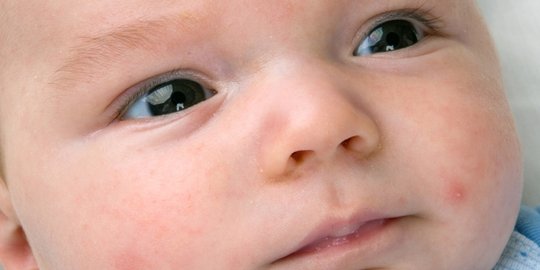 awas, 6 infeksi kulit ini mengintai halusnya kulit bayi!