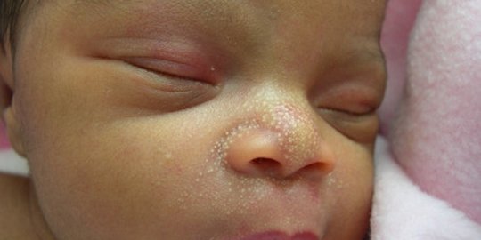 awas, 6 infeksi kulit ini mengintai halusnya kulit bayi!