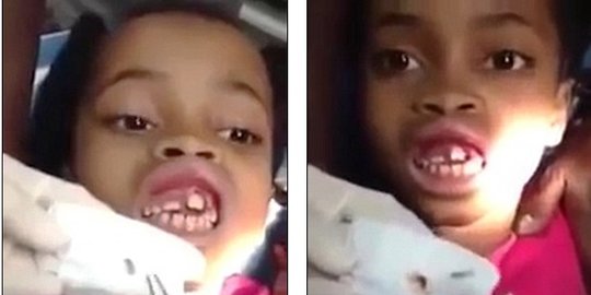 Gusi gadis cilik mendadak dipenuhi 15 belatung