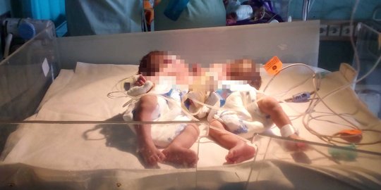 Kantongi JKBM, bayi kembar siam di Buleleng tetap tak bisa operasi