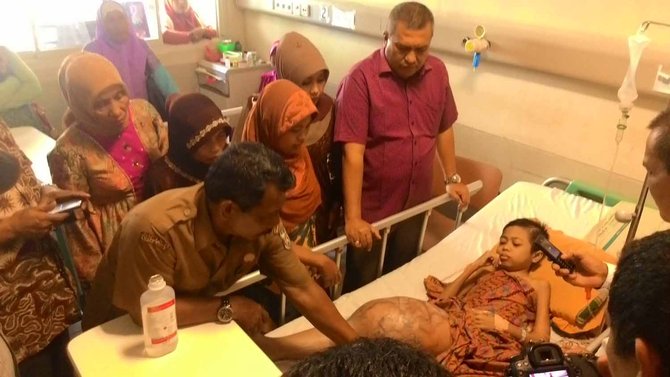 bocah aceh menderita kaki bengkak