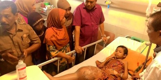 Bupati Aceh Selatan turun tangan bantu anak yang berkaki bengkak