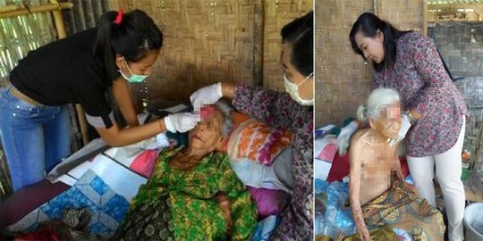 Cerita nenek renta idap kanker kulit, tak masuk daftar warga miskin