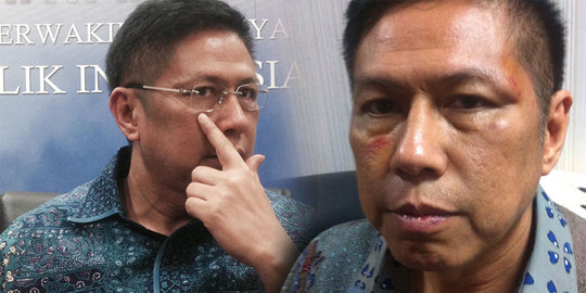 Ini penampakan lebam Mulyadi setelah dibogem Politikus PPP di DPR