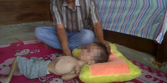 Dirujuk ke RS Medan, Naira bocah pengidap hydrocephalus butuh biaya