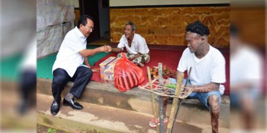 Derita Sukerti pemuda Karangasem penderita kulit bersisik di Bali