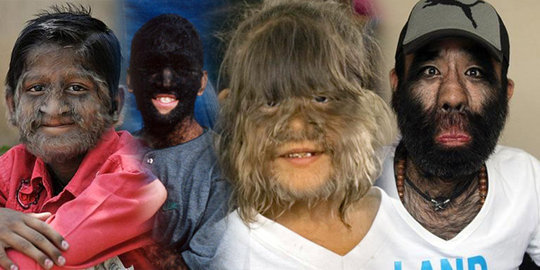 Ini 5 'manusia serigala' paling terkenal di dunia!