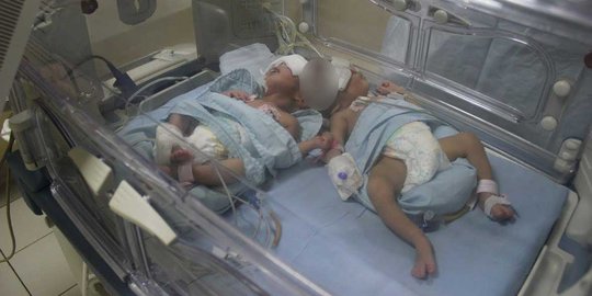 Bayi kembar siam dempet kepala hanya bisa dioperasi jika dewasa