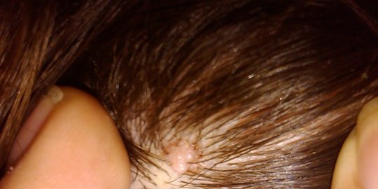 diam-diam, kanker kulit bersembunyi di 8 tempat aneh ini