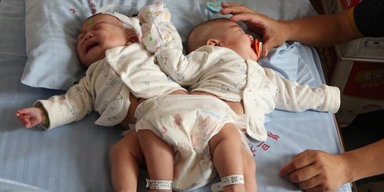 Bayi kembar siam di China berhasil dipisahkan berkat 