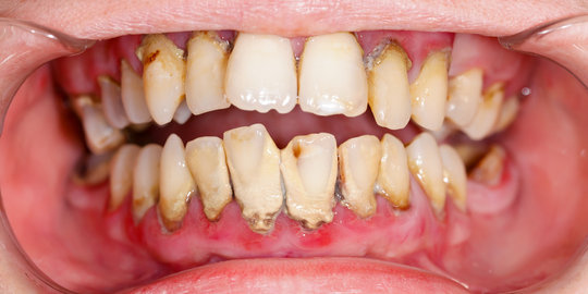 Karang gigi: Efek samping dan cara mencegahnya