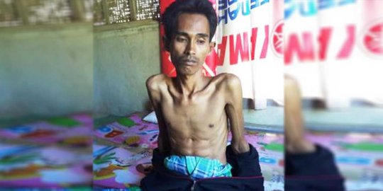 Menderita TBC kronis, Herman lemah tak berdaya di gubuk reot