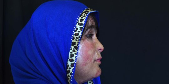 Derita wanita Afghanistan disiram air keras karena tolak dinikahkan