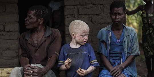 Dianggap titisan roh jahat, orang albino diburu di Tanzania