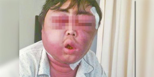 Gara-gara digigit nyamuk, wajah pria China bengkak seperti 'balon'