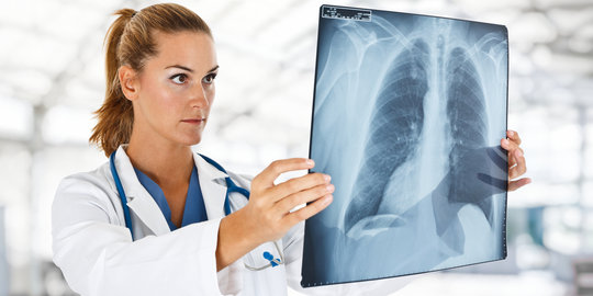 6 Hal mengejutkan tentang kanker paru-paru yang wajib diketahui