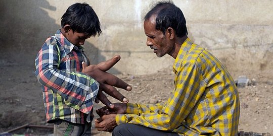 Karena penyakitnya, bocah ini dicap anak setan dan ditolak sekolah