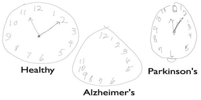 Teknologi pena digital bisa deteksi Alzheimer dan Parkinson