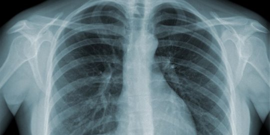 Yuk ketahui fakta-fakta penting tentang Tuberculosis!