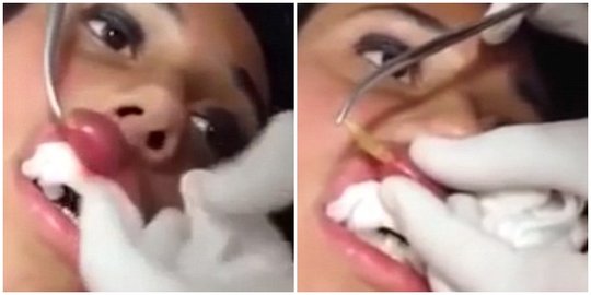 Video Dokter Keluarkan Belatung Di Bibir Wanita Ini Bikin Merinding Merdeka Com