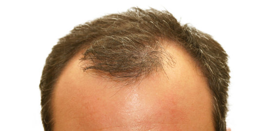 Cara-cara ini ampuh untuk samarkan rambut yang botak pada pria