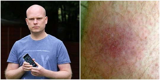 Alergi bahan iPhone 6, pria ini alami sakit kulit parah
