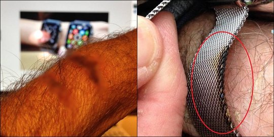 Apple Watch bakar tangan pria paruh baya asal Denmark