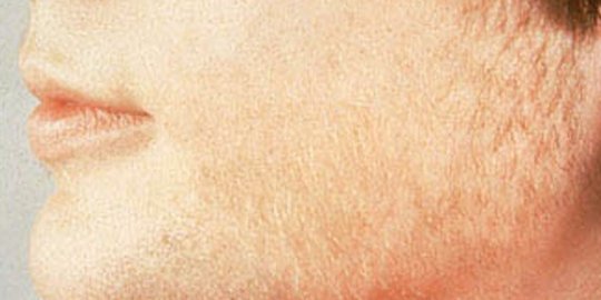 tumbuh rontoknya rambut ungkap risiko 5 penyakit ini